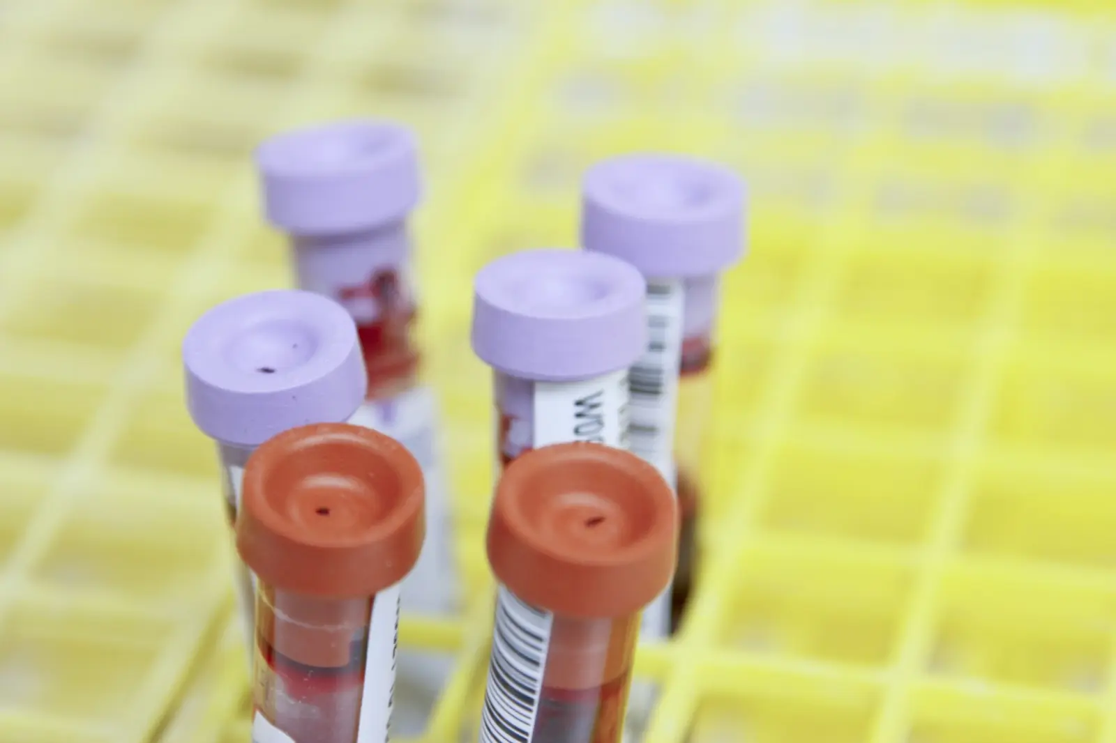Blood sample tubes arranged in a rack in a medical laboratory