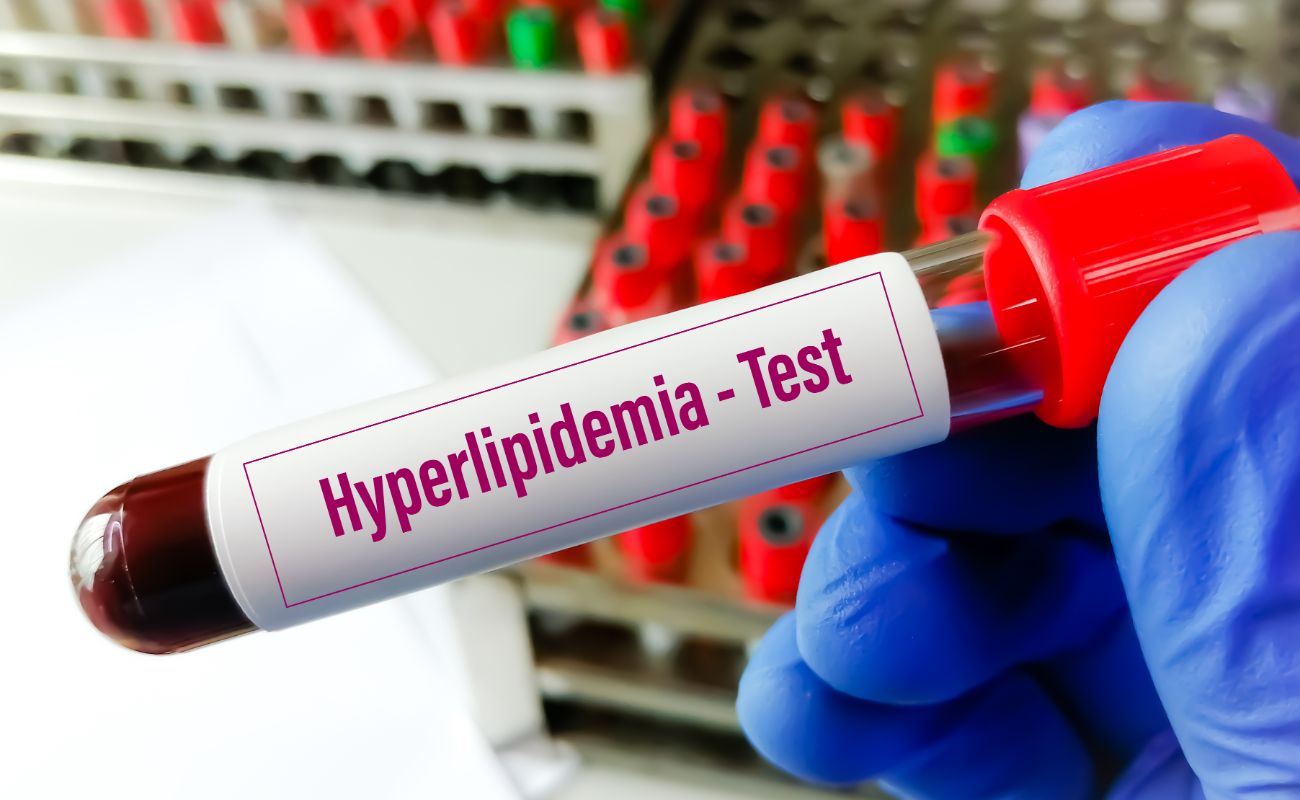 A gloved hand holds a test tube labeled "Hyperlipidemia - Test" against a background of test tubes in a rack.